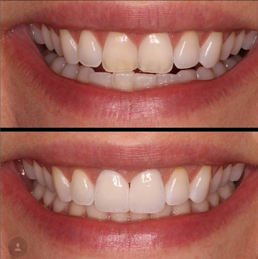 veneers colombia